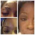 Bed bug bites on a black female skin