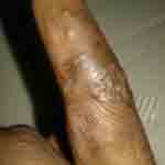 Black finger bitten by bed bugs