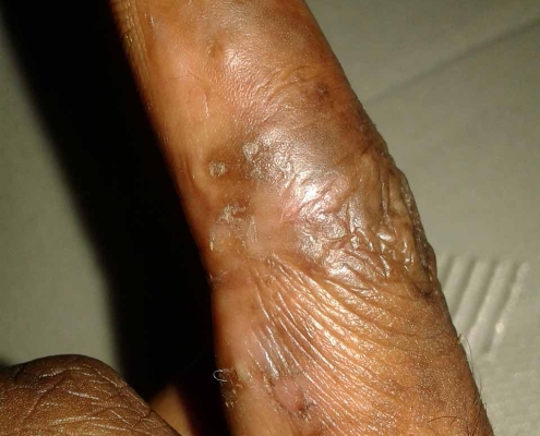 Black finger bitten by bed bugs