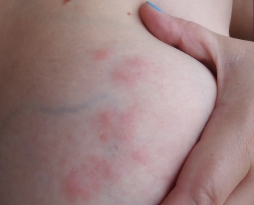 Bed bug bites in a line on breast.