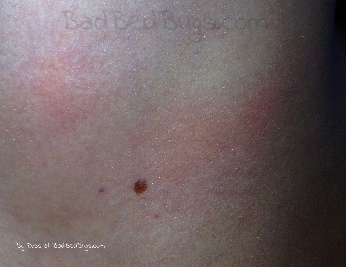 Fresh 55 Of What Do Bed Bug Bites Look Like On Face Mfvolibrosymas