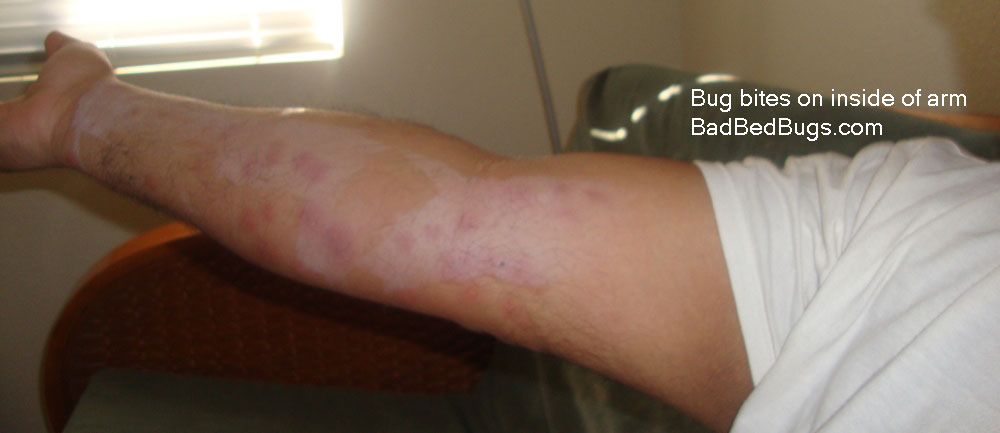 hotel bedbugs: check registry of hotels for bed bugs hotel bedbugs: check registry of hotels for bed bugs