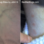 Picture of Bedbug Bites by John G 1