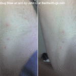 Picture of Bedbug Bites by John G 2