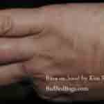 Bedbug Bites on Kim Redman Hand