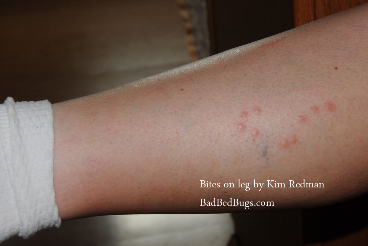 Hotel Bedbugs: Check Registry of Hotels for Bed Bugs