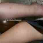 Bedbug bites on leg from Liz 3 of 3