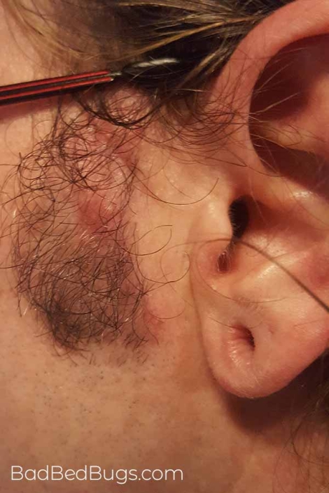 Bed bugs bit mel's face near his ear