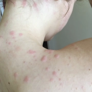 Bed bugs bites in large cluster on girl's neck and shoulders.