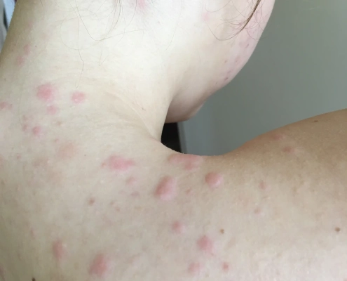 Bed bugs bites in large cluster on girl's neck and shoulders.