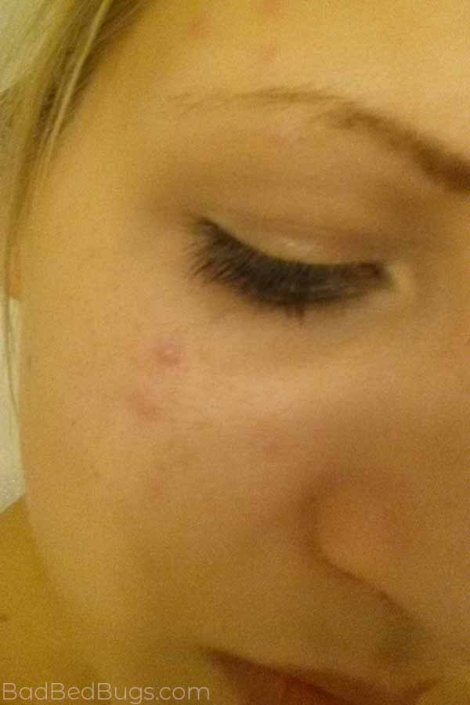 Bed bug bites on Andreas face under the eye