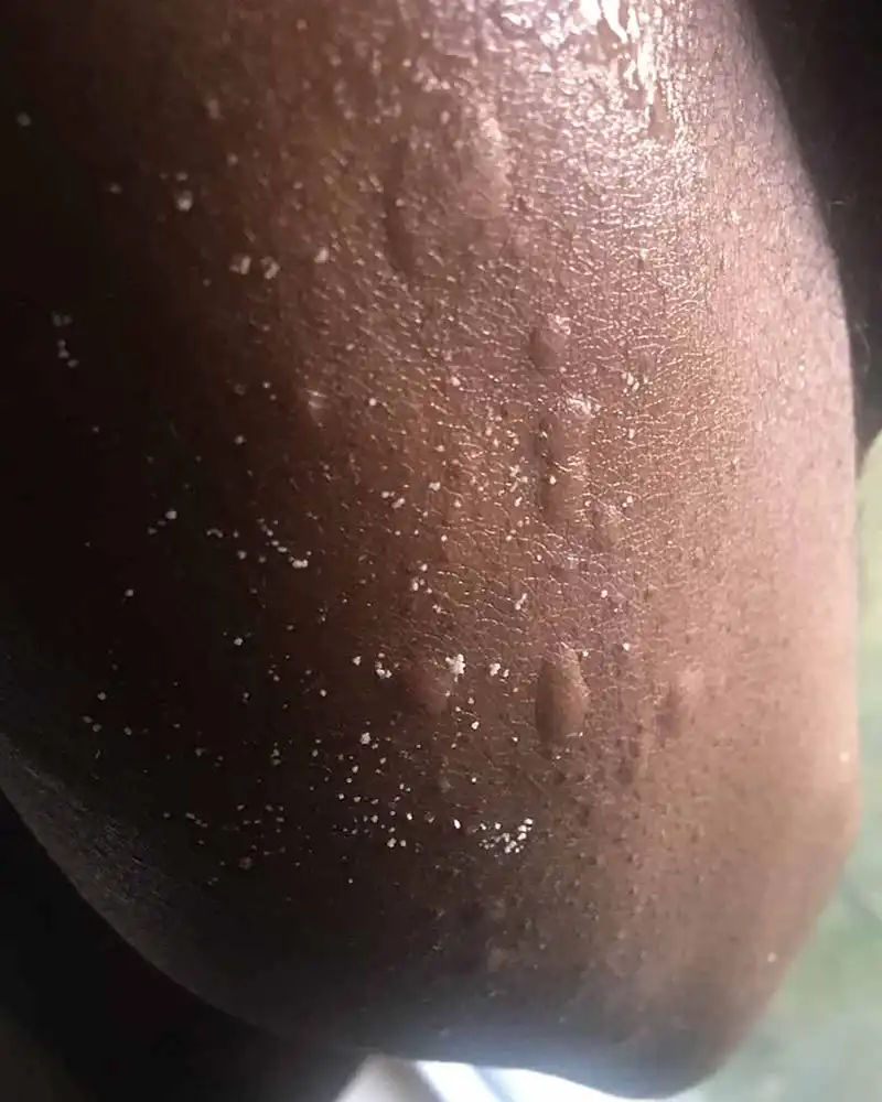 what do bed bug bites look like on black people