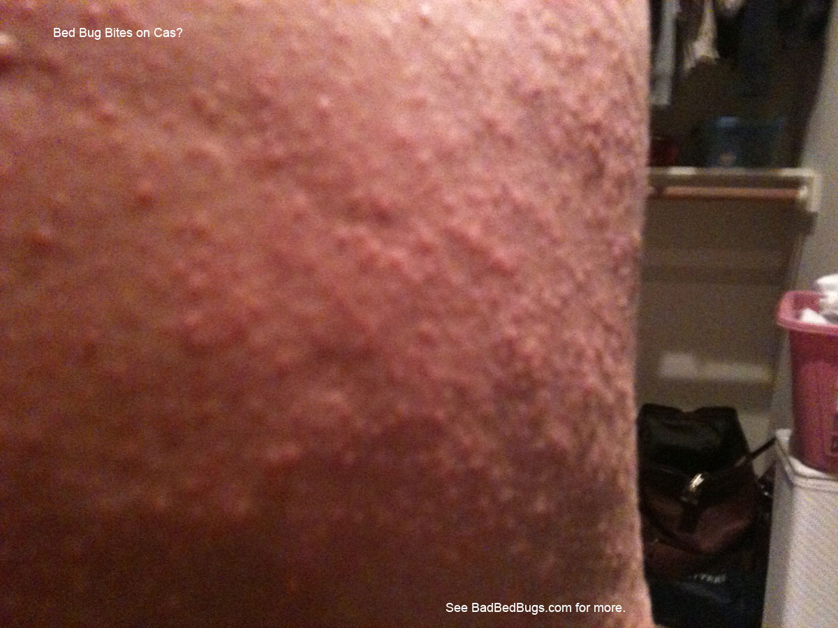 bug bite from black bug in bed. - Picture of Inn Marin & Suites, Novato -  Tripadvisor