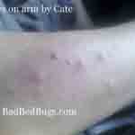 Bedbug Bites on Cate