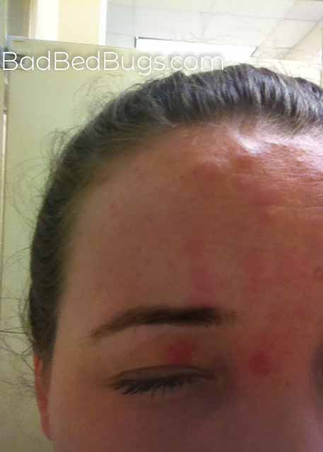 Bedbug Bites on Danielles Face and Eye