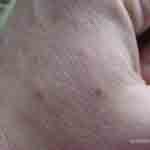Picture of bedbug bites on Debbies hand