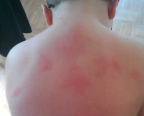 Red swelling bumps from bed bug bites.