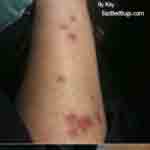 Picture of Bedbug bite on Kay's leg
