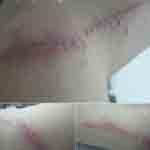 Image of Bedbug bites on Renny's arm