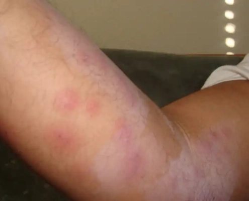 Bedbugs fed on Richard's red swollen arm.