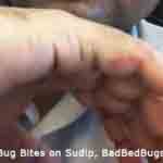 Bed bug bites on Sudip 3of3