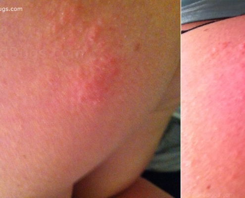 bed bug rash on butt