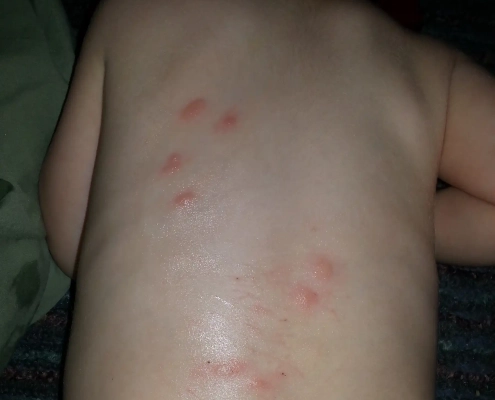 This poor baby's red swollen bites are from bed bugs.