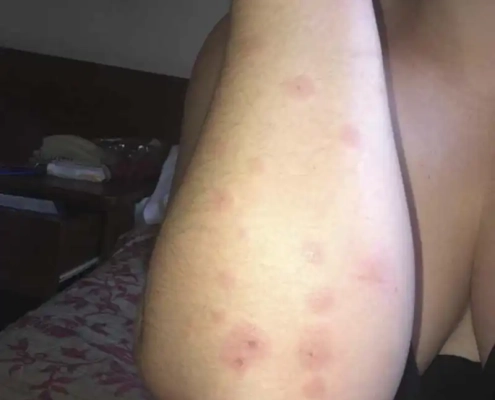 Bed bugs fed on this woman's forearm at a hotel.