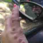 Blisters from bed bug bites on hand