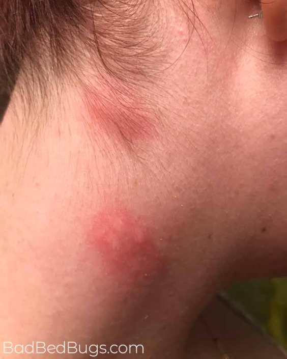 Grouping of bed bug bites on womans neck