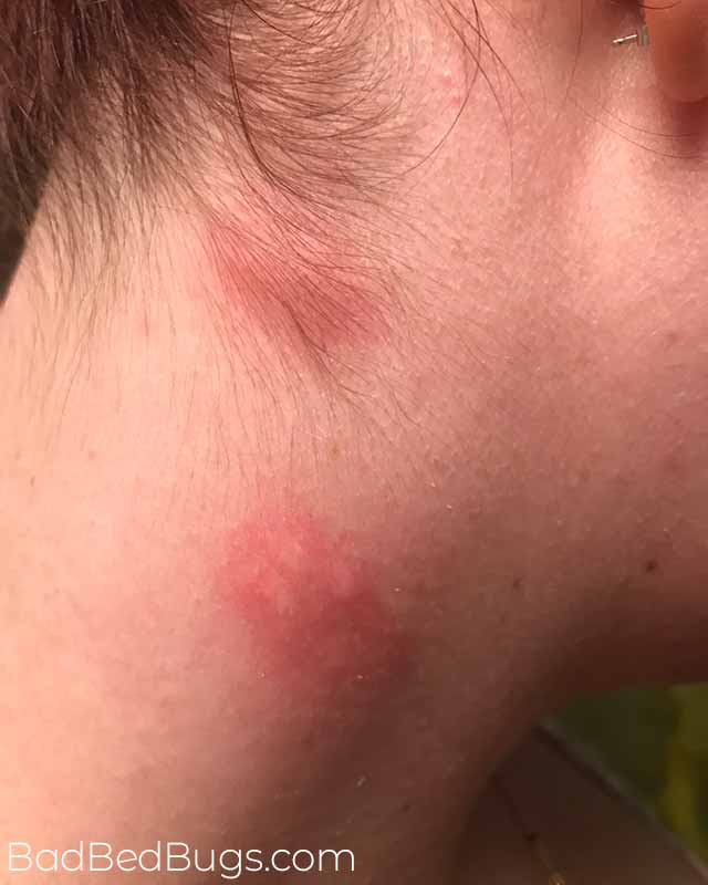 What Do Bed Bug Bites Look Like