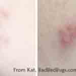 Bites on Kats leg from bed bugs