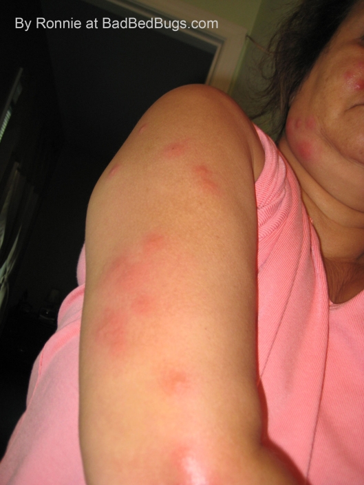 bed bug bites on face and arm with painful welts