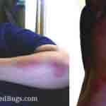 Photo of bed bug bites on Vee's arm