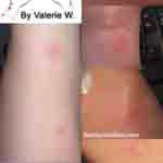 Picture of bed bug bites on Valerie