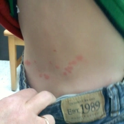 Young boy's lower back bitten by bed bugs.