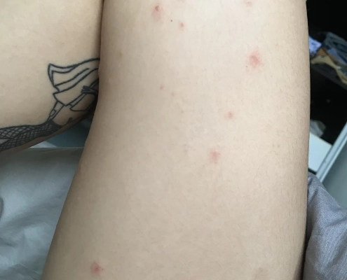 Bed bug bites on inner thigh.