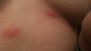 Lauren shows the bed bug bites under her breast.