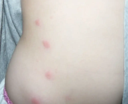 A line of bed bug bites on child's side.