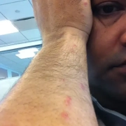 Man's arm bitten by bed bugs during hotel stay.