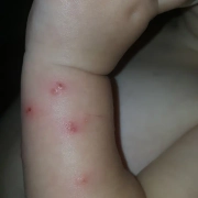 Bed bugs bit this baby's arm.
