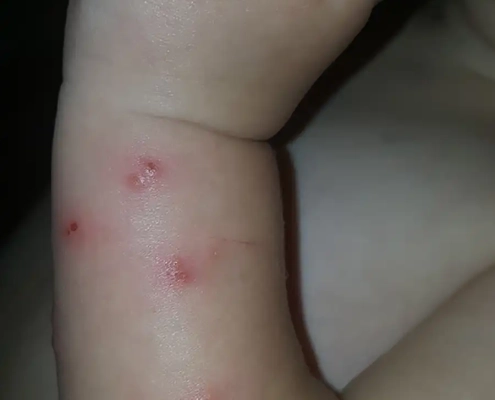 Bed bugs bit this baby's arm.