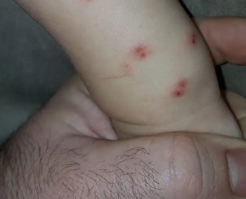 Red and swollen bites on baby's arm from bed bugs.