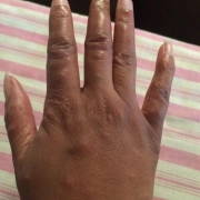 Bed bug bites on a black female hand.