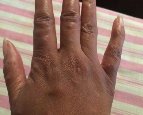 Bed bug bites on a black female hand.