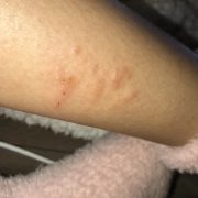 Cluster of bed bug bites on leg.