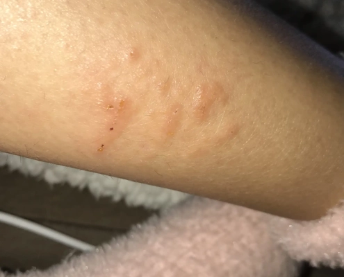 Cluster of bed bug bites on leg.