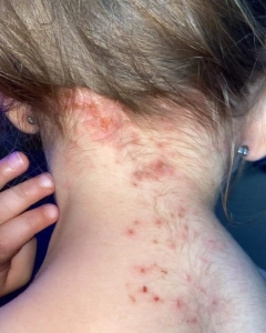 A Bed bug rash, such as this girls neck, may indicate an infestation.