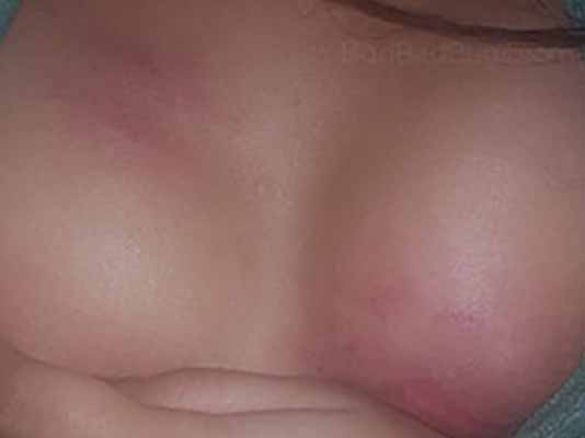 Breasts bitten by bed bugs