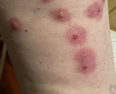 Red swollen blisters are from bed bug bites.